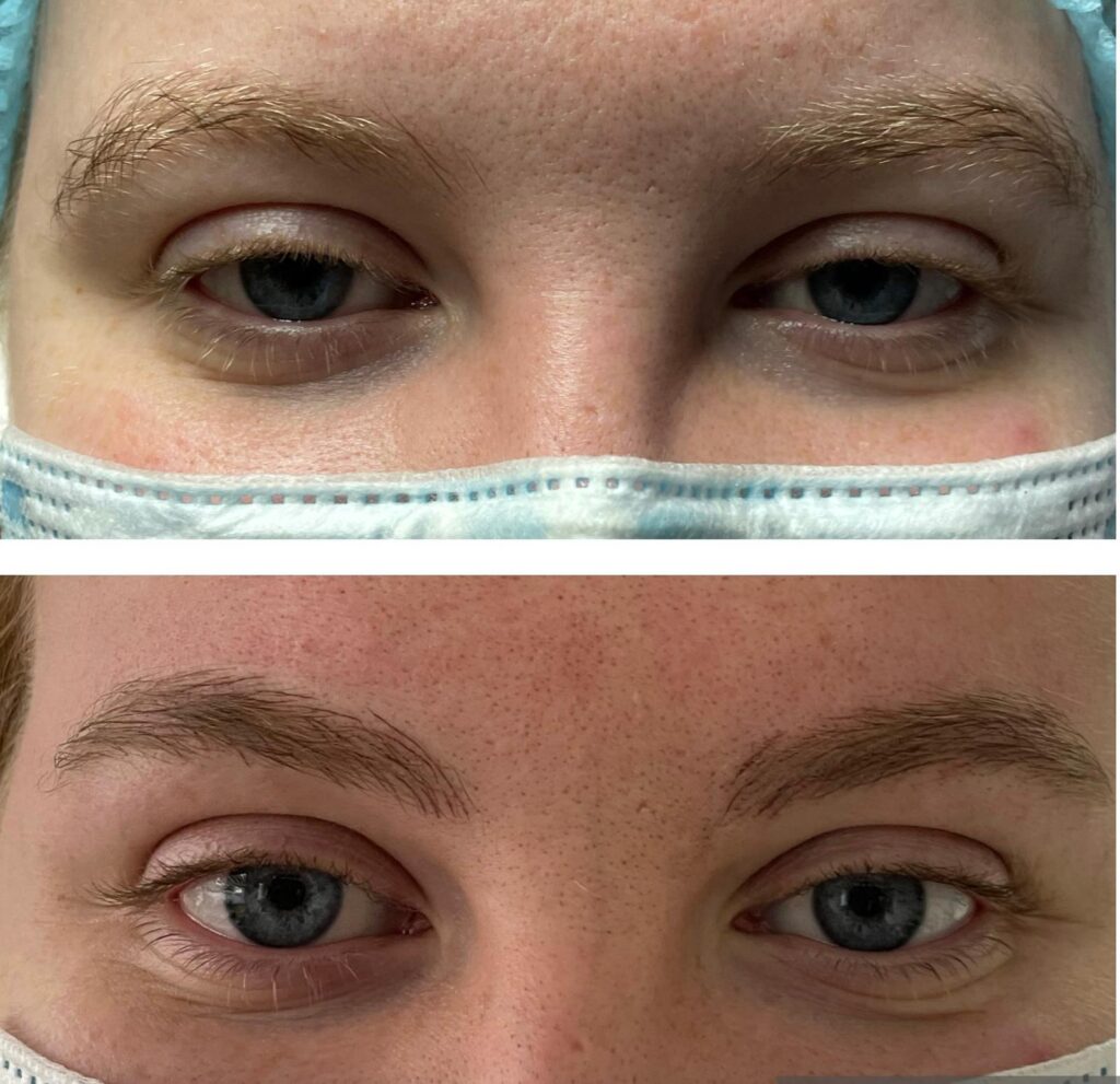 Microblading