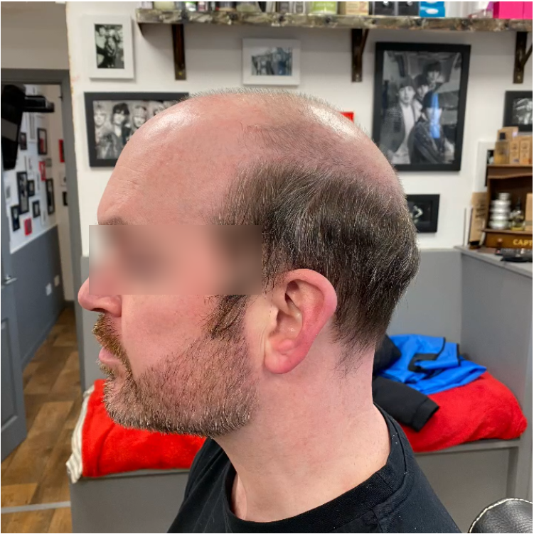 Hair transplant in {Location}