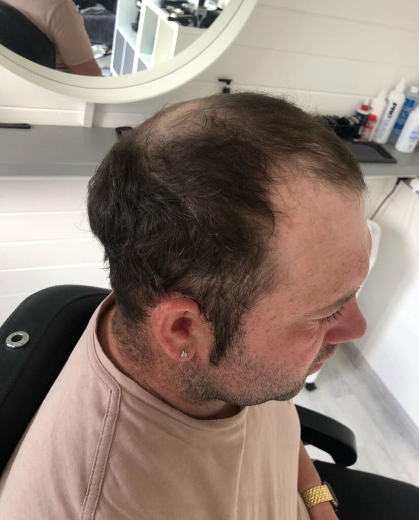 Hair Replacement Systems
