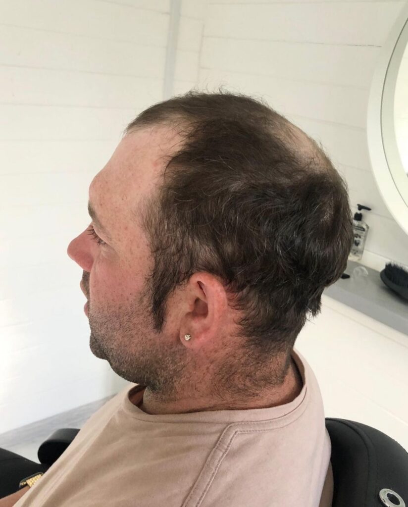 Hair replacement system in {Location}